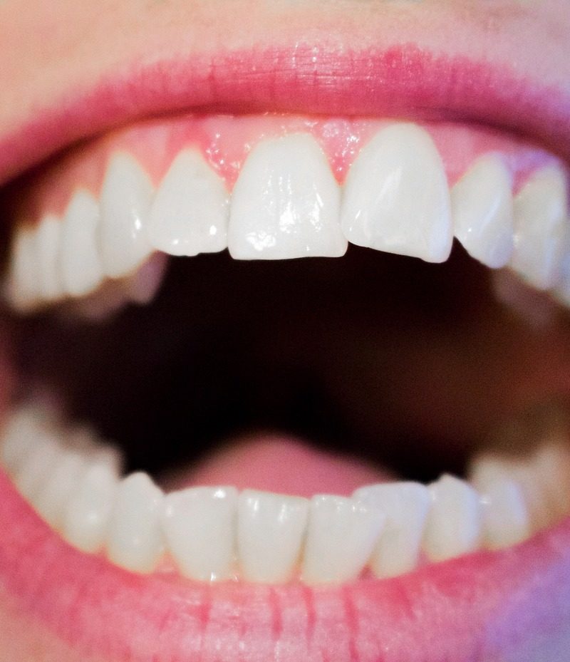 Obecna technika wykorzystywana w salonach stomatologii estetycznej może spowodować, że odzyskamy prześliczny uśmiech.